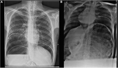 Case Report: Toxic megacolon secondary to chronic constipation and cocaine consumption